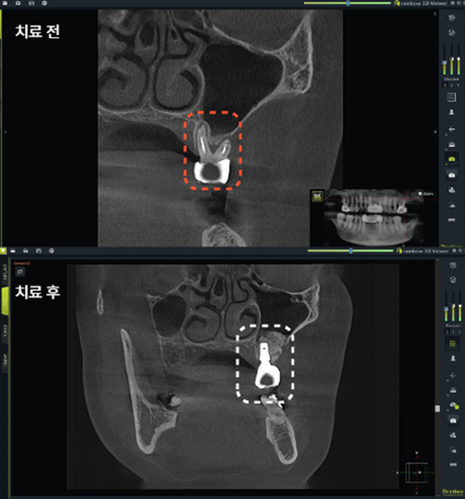 늘푸른치과 치료사례 - 아프지 않았지만 발치가 필요했던 치아, 보험임플란트 사례 - 사진 12