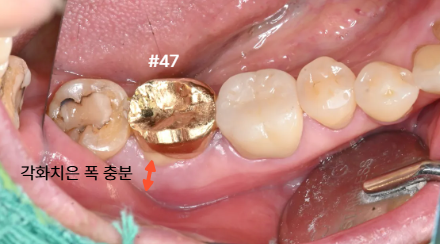 늘푸른치과 치료사례 - 골이식·잇몸이식 없이 APF만으로 진행한 임플란트 사례 - 사진 3