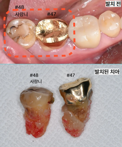 늘푸른치과 치료사례 - 골이식·잇몸이식 없이 APF만으로 진행한 임플란트 사례 - 사진 4