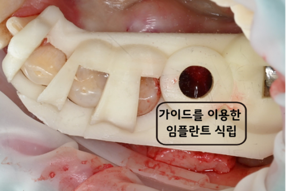 늘푸른치과 치료사례 - 크라운 탈락 어금니,APF+가이드 임플란트 수술 사례 - 사진 6