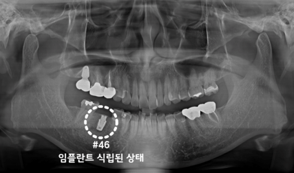 늘푸른치과 치료사례 - 크라운 탈락 어금니,APF+가이드 임플란트 수술 사례 - 사진 7