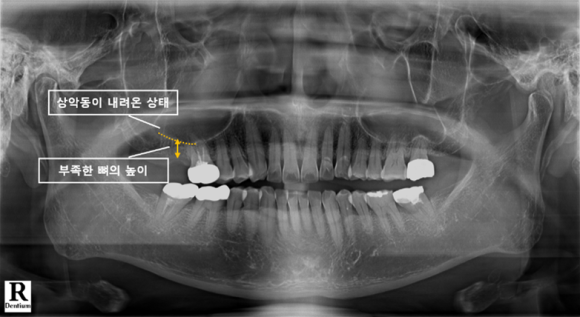 늘푸른치과 치료사례 - 무절개 임플란트와 Crestal 상악동거상술 사례 - 사진 1