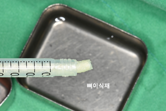 늘푸른치과 치료사례 - 무절개 임플란트와 Crestal 상악동거상술 사례 - 사진 4