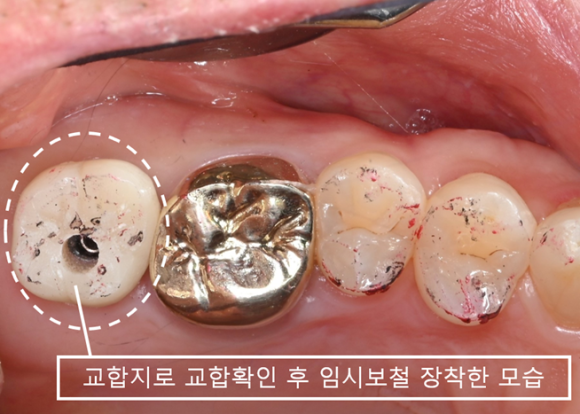 늘푸른치과 치료사례 - 무절개 임플란트와 Crestal 상악동거상술 사례 - 사진 7
