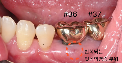 늘푸른치과 치료사례 - 임플란트, 발치와 골이식부터 잇몸이식까지 함께 진행한 사례 - 사진 1