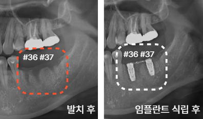 늘푸른치과 치료사례 - 임플란트, 발치와 골이식부터 잇몸이식까지 함께 진행한 사례 - 사진 4