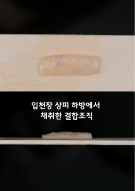 늘푸른치과 치료사례 - 치아 시림, 치은이식술로 개선한 사례 - 사진 2