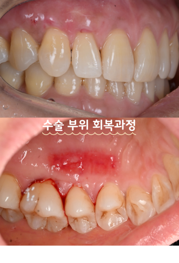 늘푸른치과 치료사례 - 치아 시림, 치은이식술로 개선한 사례 - 사진 6