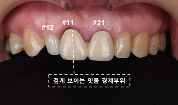 늘푸른치과 치료사례 - 앞니 보철물 주변 잇몸이 검게 보여, 지르코니아 크라운으로 교체한 사례 - 사진 1