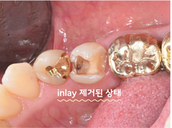 늘푸른치과 치료사례 - 예전에 떼운 치아가 깨졌다면? MTA 후 인레이로 다시 치료한 사례 - 사진 2